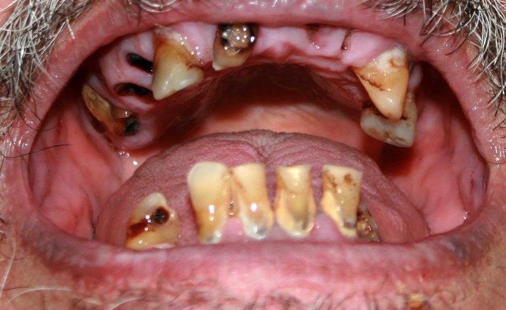 methamphetamine effects on teeth